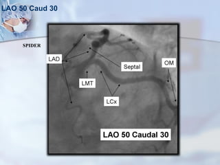 LAO 50 Caud 30
SPIDER
 