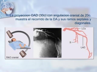 La proyeccion OAD (30o) con angulacion cranial de 20o,
muestra el recorrido de la DA y sus ramos septales y
diagonales.
 