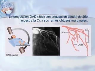 La proyeccion OAD (30o) con angulacion caudal de 25o
muestra la Cx y sus ramos obtusos marginales.
 