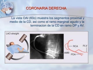CORONARIA DERECHA
La vista OAI (60o) muestra los segmentos proximal y
medio de la CD, asi como el ramo marginal agudo y la
terminacion de la CD en ramo DP y AV.
 