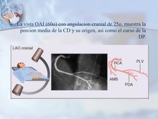 La vista OAI (60o) con angulacion cranial de 25o, muestra la
porcion media de la CD y su origen, asi como el curso de la
DP.
 