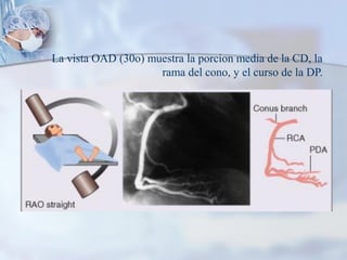 La vista OAD (30o) muestra la porcion media de la CD, la
rama del cono, y el curso de la DP.
 