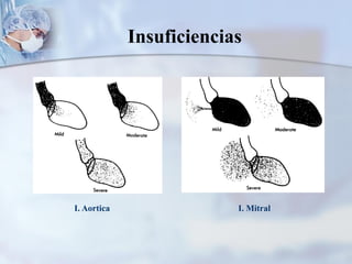 Insuficiencias
I. Aortica I. Mitral
 