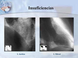 I. Aortica I. Mitral
Insuficiencias
 