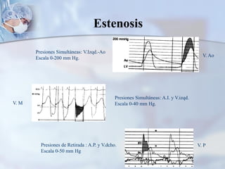 Presiones Simultáneas: V.Izqd.-Ao
Escala 0-200 mm Hg.
Presiones Simultáneas: A.I. y V.izqd.
Escala 0-40 mm Hg.
Presiones de Retirada : A.P. y V.dcho.
Escala 0-50 mm Hg
V. Ao
V. M
V. P
Estenosis
 