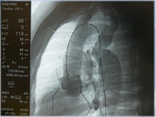 CATETERISMO CARDIACO OK.pdf
