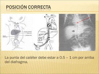    La punta del catéter debe estar a 0.5 – 1 cm por arriba
    del diafragma.
 