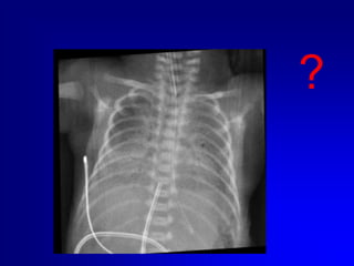 Evitare l’uso di soluzioni ipertoniche se la punta del catetere non è in vena cava inferiore 