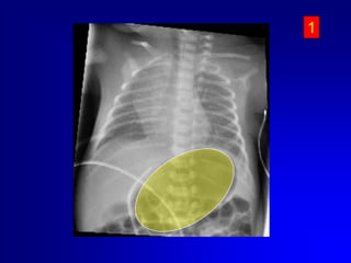  Se non è possibile passare il dotto venoso lasciare il catetere circa 2 cm dentro il piano cutaneo e valutare il ritorno ematico.