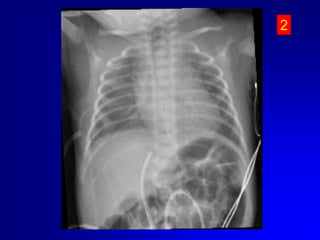 Il CVO può essere mantenuto per un tempo massimo di 14 giorni. Nei VLBW sarebbe preferibile rimuoverlo entro 7-8 giorniApplicare suzione lieve alla siringa.Se non vi è ritorno ematico vi può essere un coagulo sulla punta, quindi sfilare il catetere in aspirazione, rimuovere il cagulo e reinserire. Se vi è ritorno ematico, continuare ad inserire il catetere fino alla distanza stimata. Se il catetere incontra qualche ostruzione prima della distanza desiderata:Cause più comuniEntrato nel sistema portaleIncuneato in una branca intraepatica della vena ombelicaleRetrarre il catetere di 2-3 cm ruotarlo delicatamente e reinserirlo Se il catetere è nel circolo portale lasciare li il catetere; reinserire un altro 5–Fr nello stesso vaso. Una volta che il catetere è nella posizione giusta  si sfila quello in porta. Questa procedura ha successo nel 50% dei casi. 