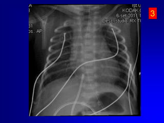 Cateterismo vena ombelicale - ComplicazioniInfezioniTromboemboliche. Se gli emboli sono infetti potranno causare numerosi ascessi. Catetere malposizionato nel cuore o nei vasi. Versamento pericardico/tamponamento cardiaco (perforazione cardiaca) Aritmie cardiacheCatetere malposizionato nel sistema portaleNECNecrosi epatica (trombosi delle vene epatiche o infusionedi soluzione ipertonica o vasospastivca nel tessuto epatico. Cisti epatiche