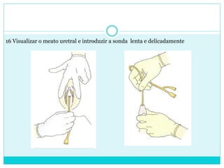 16 Visualizar o meato uretral e introduzir a sonda lenta e delicadamente
 