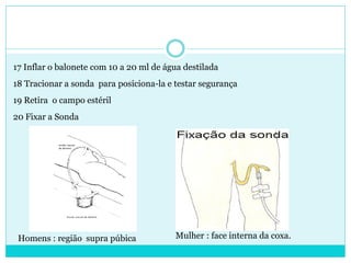 17 Inflar o balonete com 10 a 20 ml de água destilada
18 Tracionar a sonda para posiciona-la e testar segurança
19 Retira o campo estéril
20 Fixar a Sonda




 Homens : região supra púbica            Mulher : face interna da coxa.
 