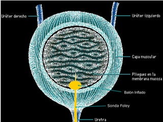 Balón Inflado


Sonda Foley
 