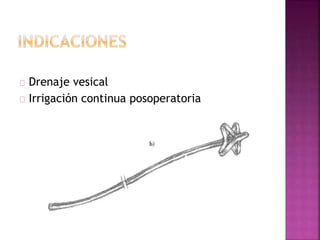 Drenaje vesical
Irrigación continua posoperatoria
 