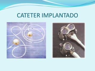 CATETER IMPLANTADO
 