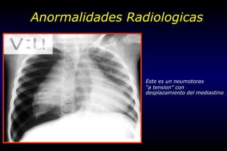 Este es un neumotorax
“a tension” con
desplazamiento del mediastino
Anormalidades Radiologicas
 