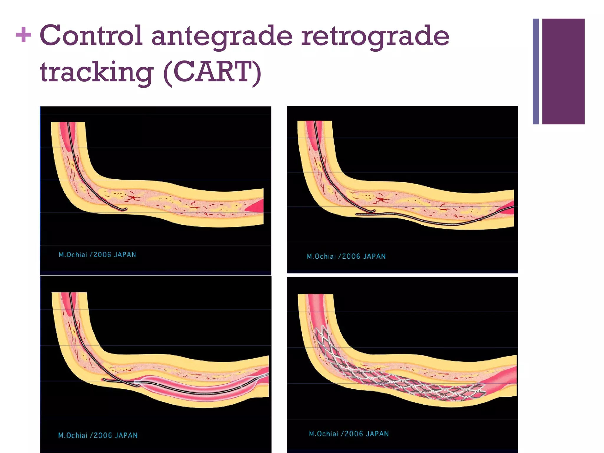 + Control antegrade retrograde
tracking (CART)
 