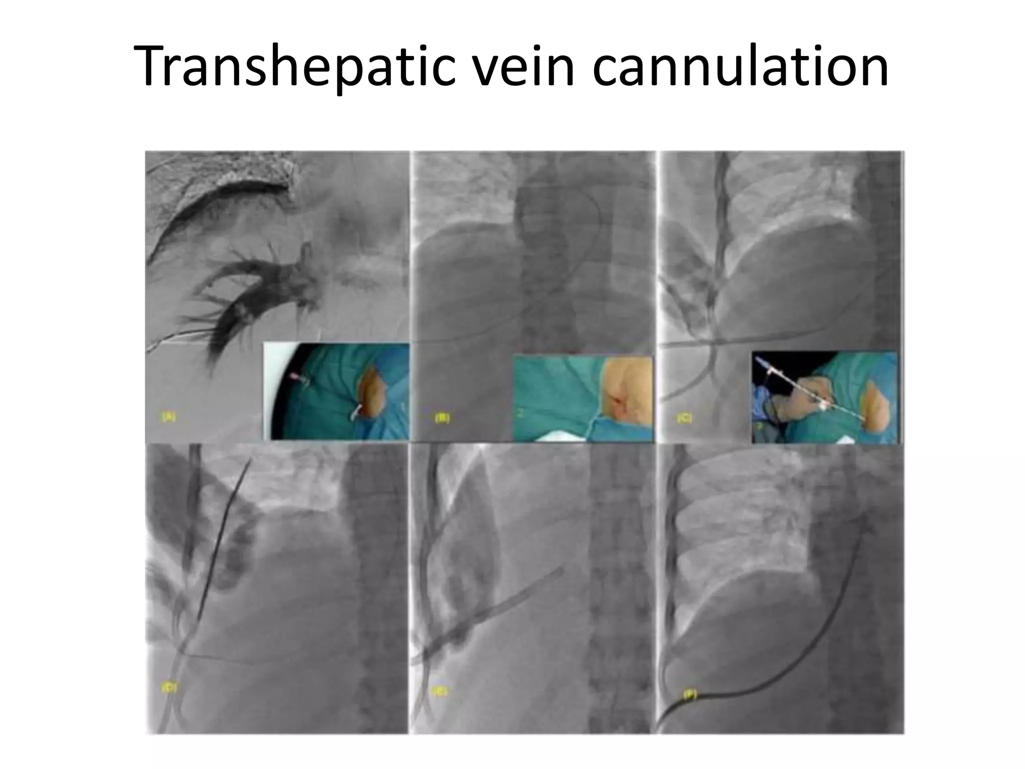 Transhepatic Approach Catheter access final | PPTX