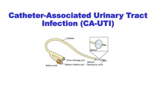 Catheter-Associated Urinary Tract
Infection (CA-UTI)
 