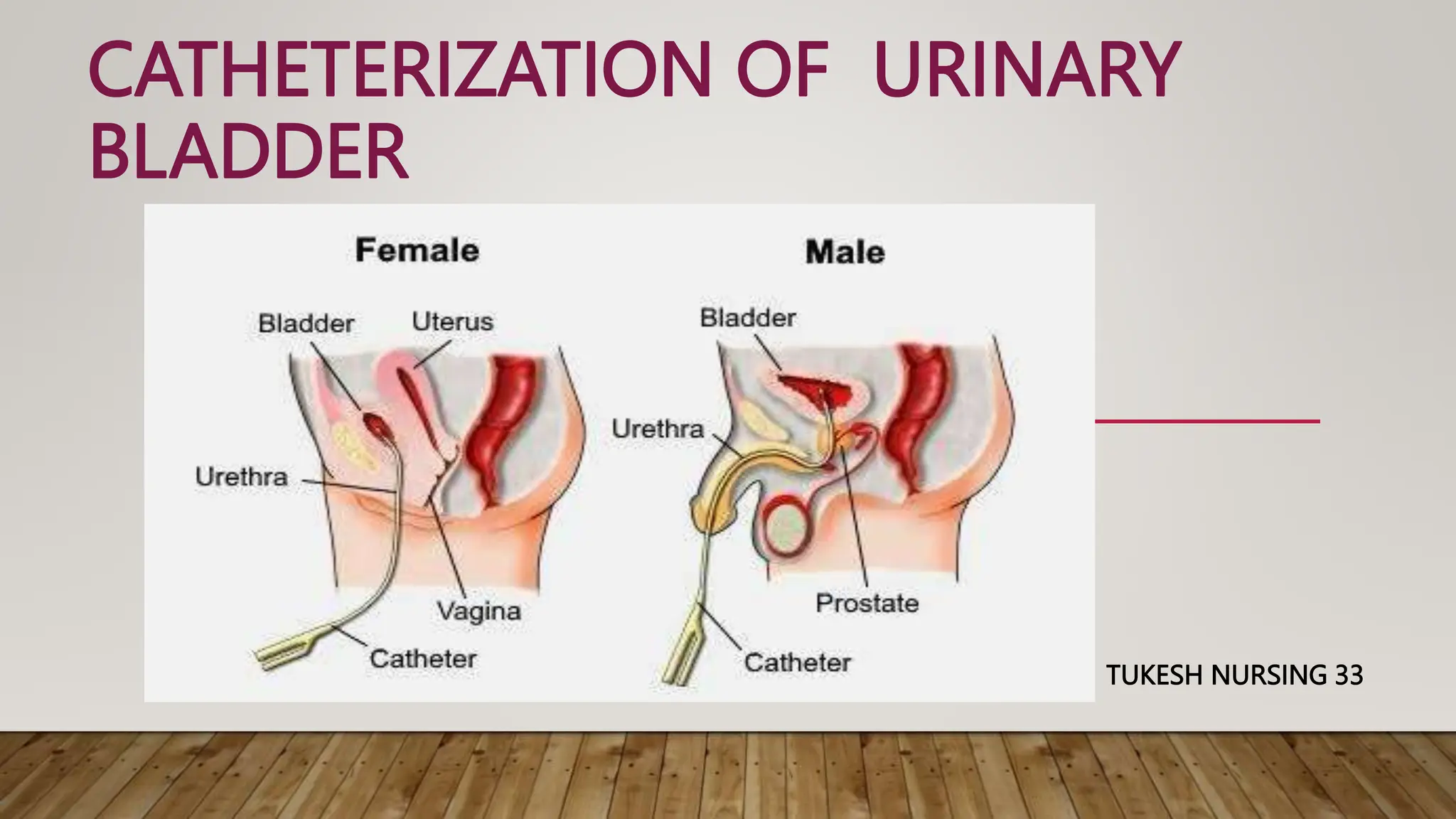 catheterization of the urinary bladder procedure , types , size of