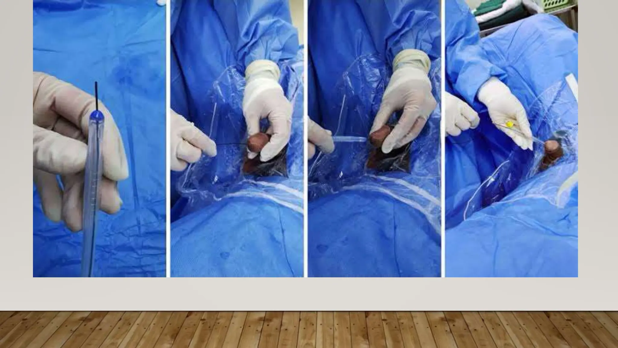 catheterization of the urinary bladder procedure , types , size of ...
