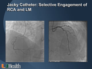 Jacky Catheter: Selective Engagement of
RCA and LM
 
