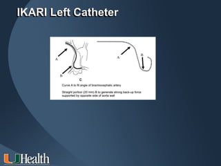 IKARI Left Catheter
 