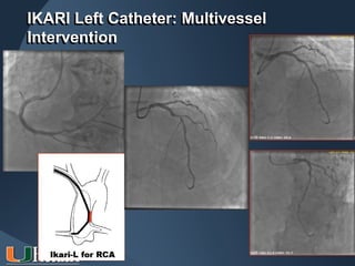 IKARI Left Catheter: Multivessel
Intervention
 