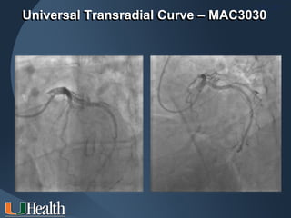 ITS 2011
Universal Transradial Curve – MAC3030
 