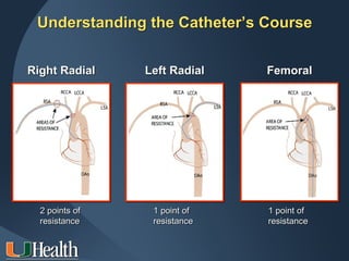 Understanding the Catheter’s Course


Right Radial    Left Radial   Femoral




  2 points of    1 point of   1 point of
  resistance     resistance   resistance
 