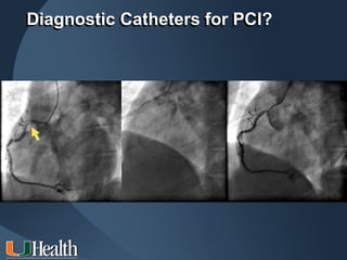 Diagnostic Catheters for PCI?
 