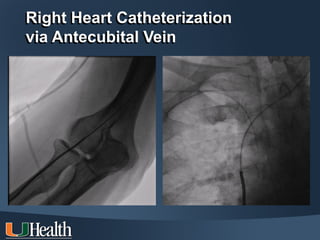 Right Heart Catheterization
via Antecubital Vein
 