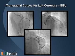 ITS 2011

Transradial Curves for Left Coronary – EBU
Transradial Curves for Left Coronary – EBU
 