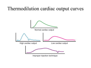 Thermodilution cardiac output curves
 