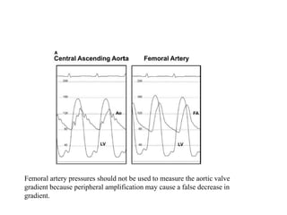 Femoral artery pressures should not be used to measure the aortic valve
gradient because peripheral amplification may cause a false decrease in
gradient.
 
