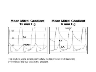 The gradient using a pulmonary artery wedge pressure will frequently
overestimate the true transmitral gradient.
 