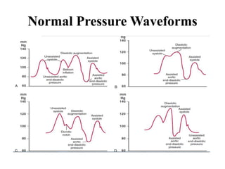 Normal Pressure Waveforms
 
