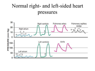 Normal right- and left-sided heart
pressures
 