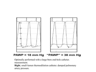 Optimally performed with a large-bore end-hole catheter.
measurement.
Right, small-lumen thermodilution catheter. damped pulmonary
artery pressure.
 