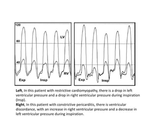 Left, In this patient with restrictive cardiomyopathy, there is a drop in left
ventricular pressure and a drop in right ventricular pressure during inspiration
(Insp).
Right, In this patient with constrictive pericarditis, there is ventricular
discordance, with an increase in right ventricular pressure and a decrease in
left ventricular pressure during inspiration.
 