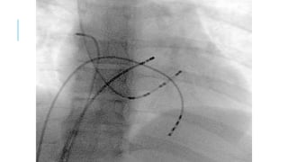 Cathlab procedures, it's contains what are the procedure doing in the ...