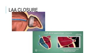 Laa Closure Algorithm Cathlab procedures, it's contains what are the procedure doing in the ...