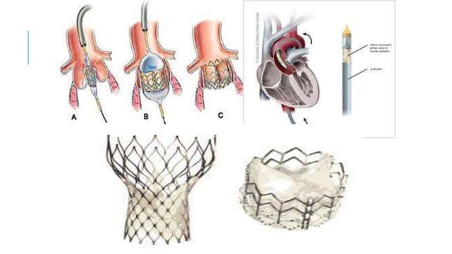 Cathlab procedures, it's contains what are the procedure doing in the ...