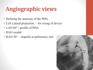 Angiographic views
• Defining the anatomy of the PDA.
• Left Lateral projection. – for sizing of device
• LAO 60 - profile of PDA
• RAO caudal
• RAO 30 – ampulla at pulmonary end
 