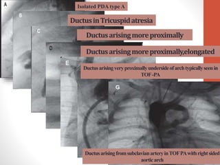 Isolated PDA type A
DuctusinTricuspidatresia
Ductusarisingmoreproximally
Ductusarisingmoreproximally,elongated
Ductusarisingveryproximallyundersideofarchtypicallyseenin
TOF-PA
DuctusarisingfromsubclavianarteryinTOFPAwithrightsided
aorticarch
 