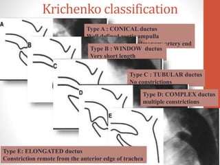 Krichenko classification
Type A : CONICAL ductus
Well defined aortic ampulla
Constriction near pulmonary artery end
Type B : WINDOW ductus
Very short length
Type C : TUBULAR ductus
No constrictions
Type D: COMPLEX ductus
multiple constrictions
Type E: ELONGATED ductus
Constriction remote from the anterior edge of trachea
 