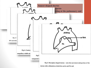 Saucer shaped ductus
Shallow depth of ductus
Hardly any narrowing at the pulmonary end
 