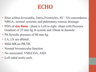 ECHO
• Situs solitus,levocardia, 2atria,2ventricles, AV –VA concordance ,
NRGA , normal systemic and pulmonary venous drainage.
• PDA of size 8mm - shunt is Left to right shunt with Pressure
Gradient of 25 mm hg in systole and 10mm in diastole.
• PA Systolic pressure of 80 mm hg.
• LA, LV are dilated .
• Mild MR,no PR,TR.
• Normal biventricular function
• No associated VSD,COA, ASD.
• Left sided aortic arch.
 
