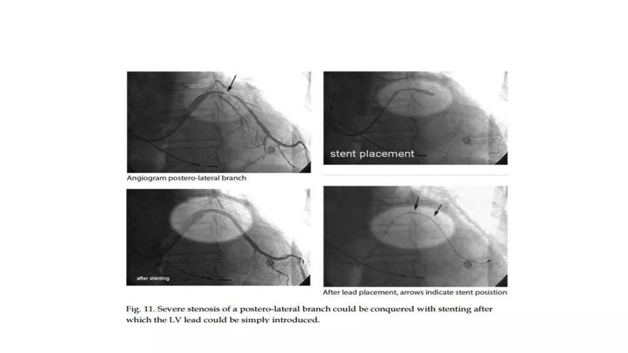 technical aspect of Left ventricular lead placement for CRT | PPTX